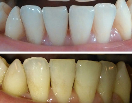 Как избавляются от зубного налёта в стоматологии?